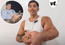Man with 20lb hands reveals the one thing strangers always get wrong about his girlfriend