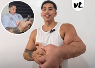 Man with 20lb hands reveals the one thing strangers always get wrong about his girlfriend
